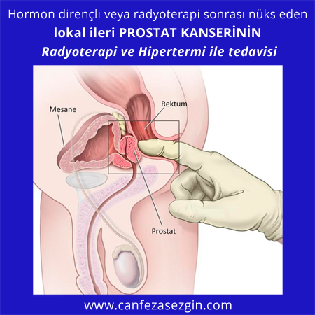 Prostatit fistula prosztata thermo kezelés után