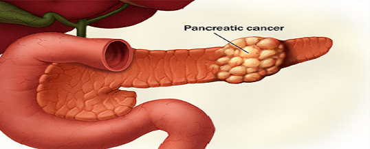 pankreas kanseri